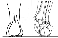 right foot pronated